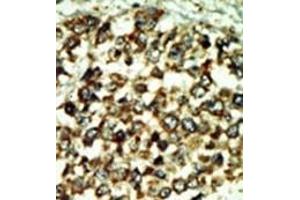 Formalin-fixed and paraffin-embedded human cancer tissue reacted with the primary antibody, which was peroxidase-conjugated to the secondary antibody, followed by DAB staining. (ATM antibody  (C-Term))