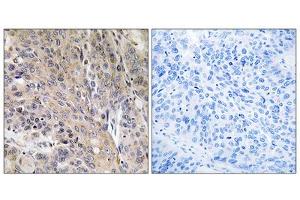 Immunohistochemistry analysis of paraffin-embedded human lung carcinoma tissue using LAMP3 antibody. (LAMP3 antibody  (Internal Region))