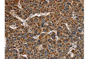 The image on the left is immunohistochemistry of paraffin-embedded Human liver cancer tissue using ABIN7128790(CAT Antibody) at dilution 1/40, on the right is treated with fusion protein. (Catalase antibody)