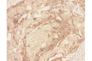 IHC-P: Eotaxin 3 antibody testing of human breast cancer tissue (CCL26 antibody  (AA 24-94))