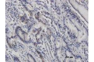 Immunohistochemistry (IHC) image for anti-Tumor Protein P53 (TP53) (pSer46) antibody (ABIN3201005) (p53 antibody  (pSer46))