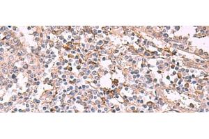 Immunohistochemistry of paraffin-embedded Human tonsil tissue using ADH1B Polyclonal Antibody at dilution of 1:55(x200)