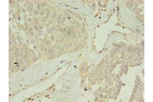 Immunohistochemistry of paraffin-embedded human endometrial cancer using ABIN7148088 at dilution of 1:100 (CCDC14 antibody  (AA 159-440))