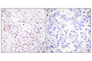 Immunohistochemistry analysis of paraffin-embedded human breast carcinoma tissue, using SENP3 antibody. (SENP3 antibody  (N-Term))