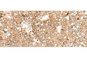 Immunohistochemistry of paraffin-embedded Human liver cancer tissue using C1S Polyclonal Antibody at dilution of 1:55(x200) (C1S antibody)