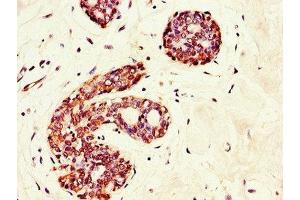 Immunohistochemistry of paraffin-embedded human breast cancer using ABIN7154388 at dilution of 1:100 (GRAMD4 antibody  (AA 23-161))