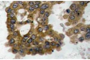Immunohistochemistry (IHC) analyzes of p-Akt2 antibody in paraffin-embedded human lung carcinoma tissue. (AKT2 antibody  (pSer474))