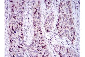 Immunohistochemical analysis of paraffin-embedded cervical cancer tissues using HDAC10 mouse mAb with DAB staining.