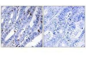 Immunohistochemistry analysis of paraffin-embedded human colon carcinoma tissue using PKA-R2β (Ab-113) antibody. (PRKAR2B antibody  (Ser113))