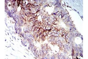 Immunohistochemical analysis of paraffin-embedded rectum cancer tissues using IGF1R-Beta mouse mAb with DAB staining. (IGF1R-beta (AA 1101-1367) antibody)