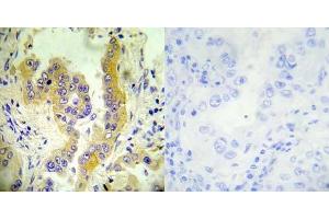 Immunohistochemical analysis of paraffin- embedded human lung carcinoma tissue using Tsc2 (Ab-1462) antibody (E022050). (Tuberin antibody)