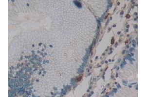 Detection of DNM2 in Human Stomach cancer Tissue using Polyclonal Antibody to Dynamin 2 (DNM2)