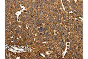 The image on the left is immunohistochemistry of paraffin-embedded Human ovarian cancer tissue using ABIN7129340(EIF2AK3 Antibody) at dilution 1/40, on the right is treated with fusion protein. (COQ3 antibody)