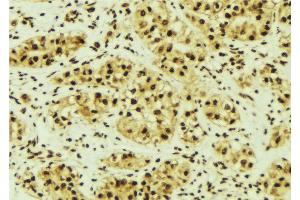 ABIN6268996 at 1/100 staining Human breast cancer tissue by IHC-P. (PRKACA antibody  (Internal Region))