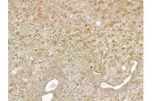 ABIN6257766 and ABIN6275152 at 1/100 staining human thyroid carcinoma by IHC-P.