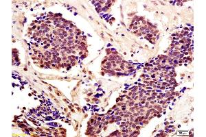 Formalin-fixed and paraffin embedded human lung carcinoma with labeled Anti-Cytomegalovirus pp65 Polyclonal Antibody, Unconjugated (ABIN738276) at 1:200, followed by conjugation to the secondary antibody and DAB staining (STAT5A antibody  (AA 61-160))