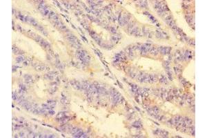 Immunohistochemistry of paraffin-embedded human endometrial cancer using ABIN7142866 at dilution of 1:100 (MMP2 antibody  (AA 445-660))