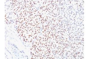 Formalin-fixed, paraffin-embedded human Melanoma stained with MITF Mouse Monoclonal Antibody (D5). (MITF antibody)