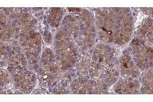 ABIN6273981 at 1/100 staining Human liver cancer tissue by IHC-P. (OR2S2 antibody  (C-Term))