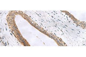 Immunohistochemistry of paraffin-embedded Human breast cancer tissue using CEMIP Polyclonal Antibody at dilution of 1:120(x200) (CEMIP antibody)
