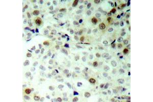 Immunohistochemistry of paraffin-embedded human breast carcinoma using Phospho-CDK2-T160 antibody (ABIN2987938). (CDK2 antibody  (pThr160))