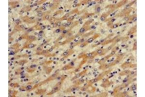 Immunohistochemistry of paraffin-embedded human liver cancer using ABIN7170287 at dilution of 1:100
