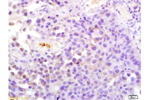 Formalin-fixed and paraffin embedded human bladder carcinoma labeled with Anti-ATP1A1 Polyclonal Antibody, Unconjugated (ABIN705956) at 1:200 followed by conjugation to the secondary antibody and DAB staining. (ATP1A1 antibody  (AA 901-1023))