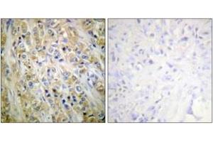 Immunohistochemistry analysis of paraffin-embedded human prostate carcinoma tissue, using Prostate-specific Antigen Antibody. (Prostate Specific Antigen antibody  (AA 81-130))