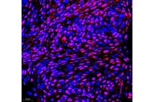 Immunofluorescence of paraffin embedded human cervical cancer using PABPN1 (ABIN7075116) at dilution of 1:600 (400x lens) (PABPN1 antibody)