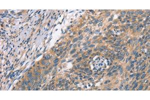Immunohistochemistry of paraffin-embedded Human cervical cancer using PLEKHO1 Polyclonal Antibody at dilution of 1:70 (PLEKHO1 antibody)