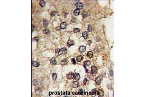 Formalin-fixed and paraffin-embedded human prostata carcinoma tissue reacted with CLOCK antibody , which was peroxidase-conjugated to the secondary antibody, followed by DAB staining.