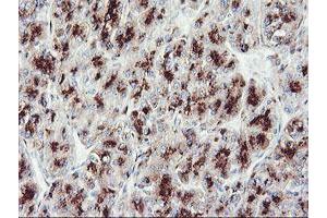 Immunohistochemical staining of paraffin-embedded Carcinoma of Human liver tissue using anti-GOLM1 mouse monoclonal antibody.