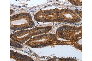 Immunohistochemistry of Human lung cancer using PDCD7 Polyclonal Antibody at dilution of 1:60 (PDCD7 antibody)