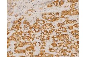 Immunohistochemistry analysis of liver Cancer using GOT2 Antibody at a dilution of (1/100 200x). (GOT2 antibody)