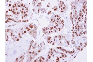 IHC-P Image Immunohistochemical analysis of paraffin-embedded human ovarian cancer, using C/EBP beta, antibody at 1:250 dilution. (CEBPB antibody  (N-Term))