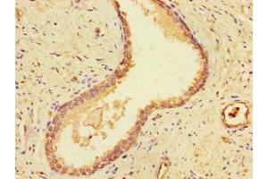 Immunohistochemistry of paraffin-embedded human prostate cancer using ABIN7149795 at dilution of 1:100 (Destrin antibody  (AA 2-165))