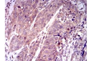 Immunohistochemical analysis of paraffin-embedded bladder cancer tissues using KEAP1 mouse mAb with DAB staining. (KEAP1 antibody  (AA 380-624))