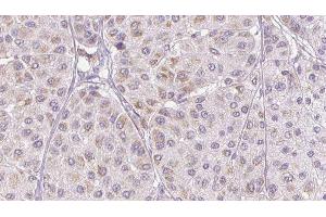 ABIN6276810 at 1/100 staining Human melanoma tissue by IHC-P. (PEDF antibody  (C-Term))