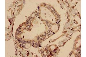 Immunohistochemistry analysis of human pancreatic cancer using ABIN7147768 at dilution of 1:100 (CFAP61 antibody  (AA 1-200))