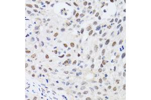 Immunohistochemistry of paraffin-embedded human lung cancer using CBX4 antibody. (CBX4 antibody)
