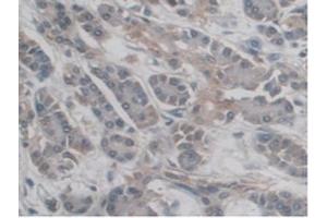 IHC-P analysis of Human Pancreas Cancer Tissue, with DAB staining. (DC-SIGN/CD209 antibody  (AA 70-404))