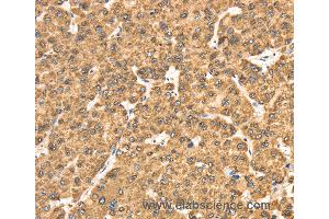 Immunohistochemistry of Human liver cancer using RRBP1 Polyclonal Antibody at dilution of 1:25