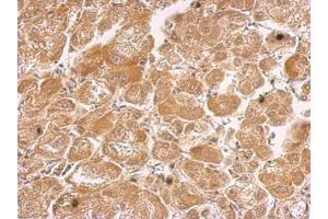 IHC-P Image HHIP antibody [N3C2], Internal detects HHIP protein at cytosol on human hepatoma by immunohistochemical analysis. (HHIP antibody)