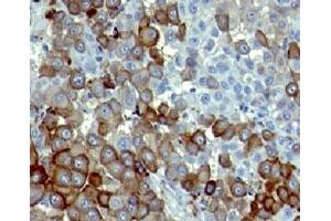 Formalin-fixed, paraffin-embedded human melanoma stained with NGFR antibody (NTR/912). (NGFR antibody)