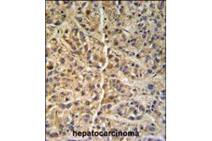 GNS Antibody (Center S298) IHC analysis in formalin fixed and paraffin embedded human hepatocarcinoma followed by peroxidase conjugation of the secondary antibody and DAB staining. (GNS antibody  (AA 283-313))