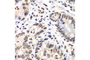 Immunohistochemistry of paraffin-embedded human gastric cancer using RBBP7 antibody (ABIN6290864) at dilution of 1:100 (40x lens).