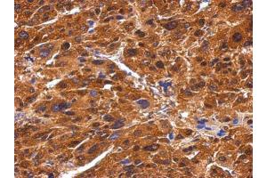 IHC-P Image Immunohistochemical analysis of paraffin-embedded human hepatoma, using BIVM, antibody at 1:500 dilution. (BIVM antibody  (C-Term))