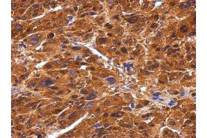 IHC-P Image Immunohistochemical analysis of paraffin-embedded human hepatoma, using BIVM, antibody at 1:500 dilution.
