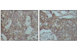 Immunohistochemical analysis of paraffin-embedded human breast carcinoma tissues, showing membrane localization with DAB staining using CD44 mouse mAb. (CD44 antibody)