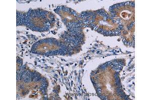 Immunohistochemistry of Human colon cancer using ITK Polyclonal Antibody at dilution of 1:50